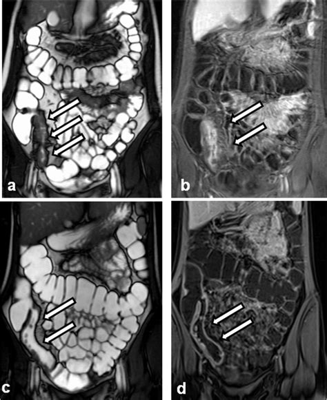 Magnetic Resonance Enterography Images Illustrating An Example Of A