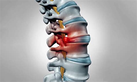 Typowe Objawy Przepukliny Dysku Fimedica