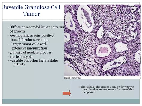 Sex Cord Stromal Tumors Pathology Ppt