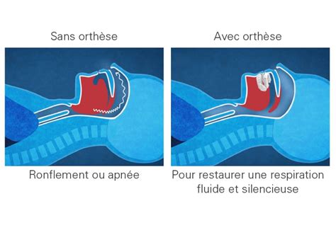 Traitement par OAM Syndrome Apnées du Sommeil