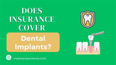 Does Insurance Cover Dental Implants In USA Complete Anwser 2024