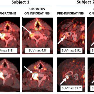 18FFDGPET CT 68GaDOTATATEPET CT And 68GaDOTATOCPET CT Scans