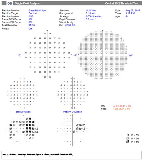 Visual Field Test Glaucoma