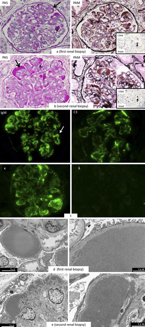 Figure1 The Renal Biopsy Findings In Case 1 A Light Microscopy Of The