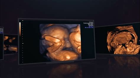 20 weeks scan ultrasound 2D 3D 4D ultrasound bone mode, color doppler ...