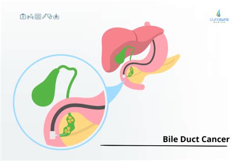 Understanding Cholangiocarcinoma Symptoms Diagnosis And Treatment