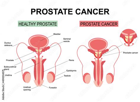 Prostate Cancer On White Background Illustration Anatomy Of The Male