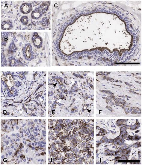 PTPRJ Localization In Normal And Cancerous Human Breast A C