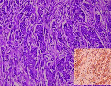 Histological Section Of Invasive Carcinoma Of No Special Type Grade Download Scientific