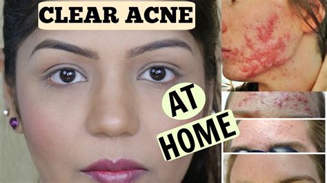 How To Cure Acne Fast And Overnight And Skin Lightening Face Mask