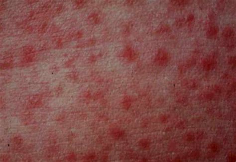 Hiv Rash Pictures Symptoms Causes Treatment