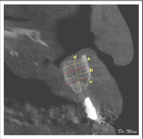 Figure From A New Technique In Alveolar Cleft Bone Grafting For