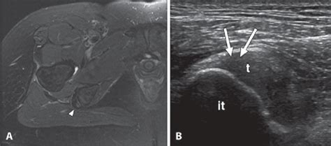 Hamstring Tendon Ultrasound