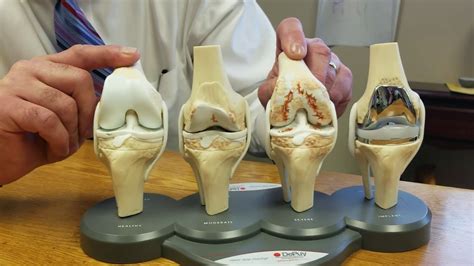 Total Knee Replacement Teknik Indikasi Komplikasi