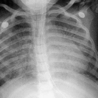 Anteroposterior Chest Radiograph Taken Days After Admission