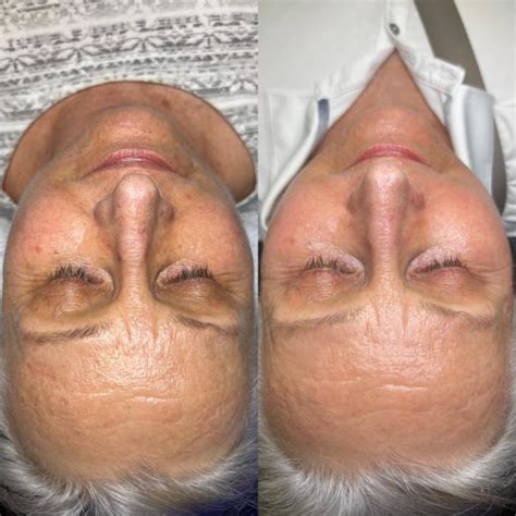 Facials Before And After Photo Gallery Tampa Bay North Palm Beach Fl The Garden Medical Spa