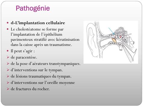 Ppt Lotite Moyenne Chronique Cholestéatomateuse Powerpoint