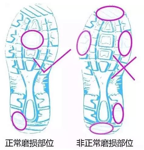 鞋底这7个位置磨损，预示身体疾病 知乎