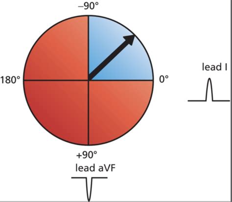 Ekg Hypertrophy Enlargement Flashcards Quizlet