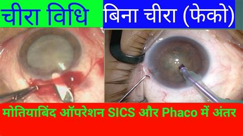 Cataract Surgery Different Sics And Phaco। मोतियाबिंद ऑपरेशन Sics और