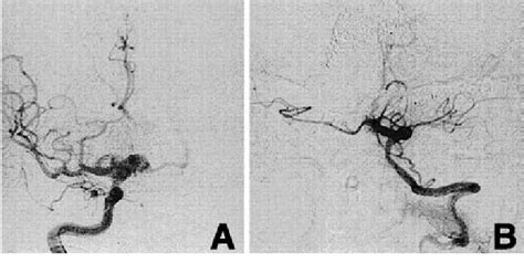 Postoperative Angiograms A Right Carotid Angiogram Anteroposterior