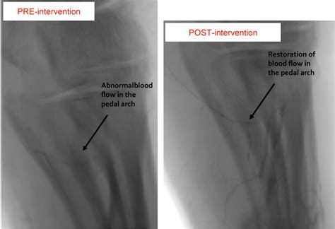 Transpedal Approach For The Treatment Of Acute Limb Ischemia In A Patient With Limited Access Sites