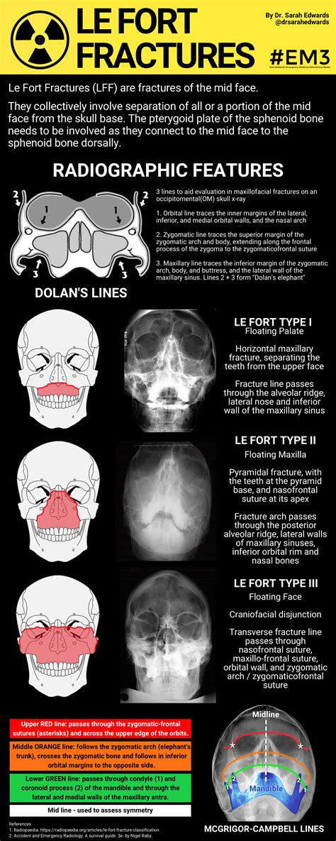 Le Fort Fractures : r/emergencymedicine