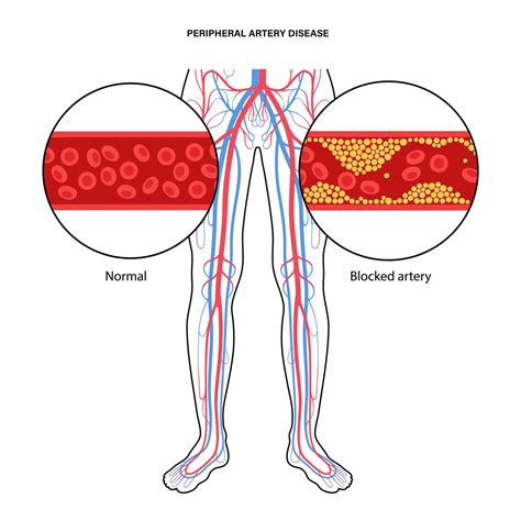 PAD Symptoms and Causes - Premier Vascular & Vein Center, TN