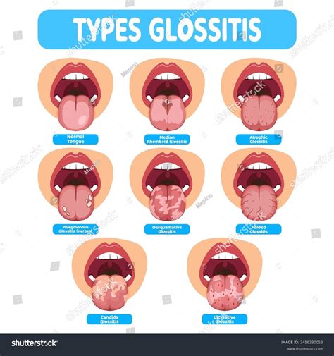 Illustration Of The Oral Infection Disease Royalty Free Stock Vector 2456380053