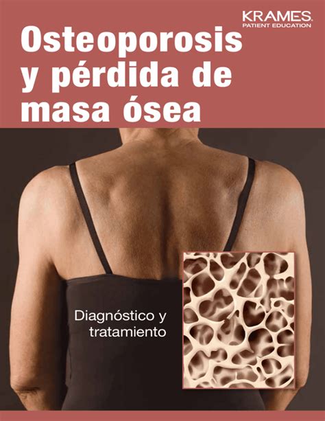 Osteoporosis Y P Rdida De Masa Sea