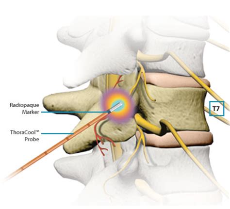 Radiofrequency Ablation Rhizotomy Pain Treatment And Procedure