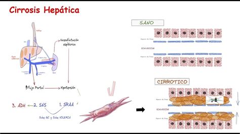 Cirrosis Hepática Fisiopatología Que Es La Cirrosis Hepática Causas