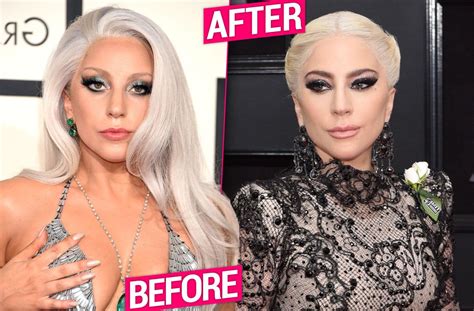 Did Lady Gaga Get Plastic Surgery For Grammys Singer Underwent Brow Lift Doctors Claim