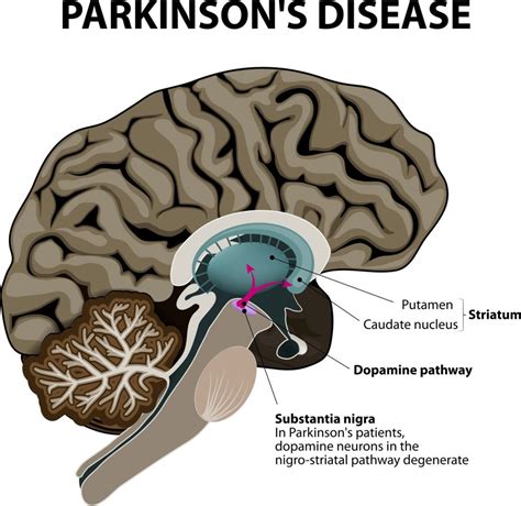 Causes Parkinson's Disease Brain