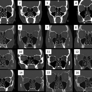 Computed tomography (CT) scan findings of patients. Sinus CT scans of ...