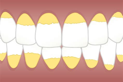 Formação de tártaro nos dentes veja como ocorre o tratamento e 4 dicas