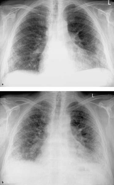 Fibrosing Lung Disease Radiology Key