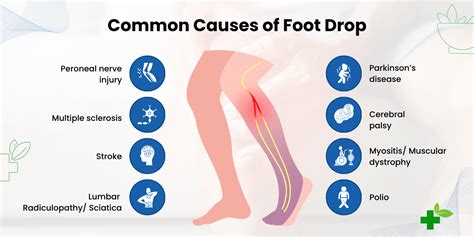 Foot Drop Causes Symptoms And Treatment Pmri Homoeo Hall