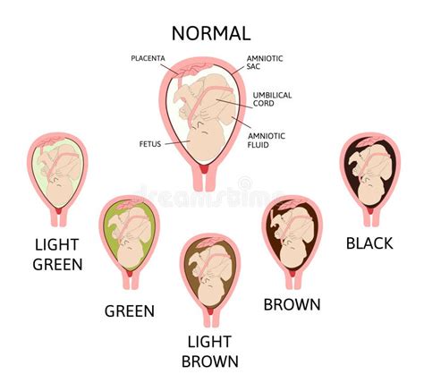 Color of Amniotic Fluid in the Amniotic Sac. Normal and Danger Variants ...