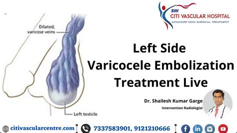 Varicocele Embolization Treatment Live Varicocele Surgery Honest