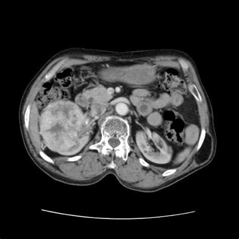 Axial Section Of Ct Scan Showing Renal Mass With Extension In Ivc