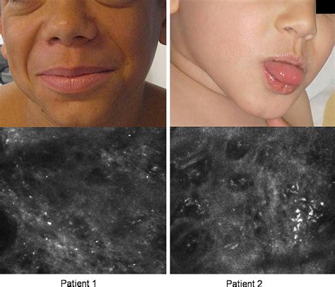 In Vivo Reflectance Confocal Microscopy Of The Skin A Noninvasive