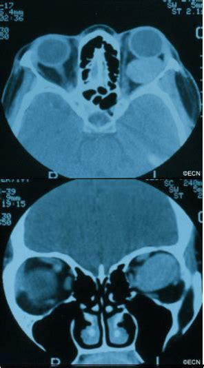 Cavernous Hemangioma of the Orbit » New York Eye Cancer Center