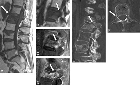 Pedicle Involvement On MR Imaging Is Common In Osteoporotic Compression