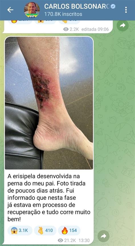 Carlos Bolsonaro Publica Foto Da Perna Do Pai Erisipela Metr Poles