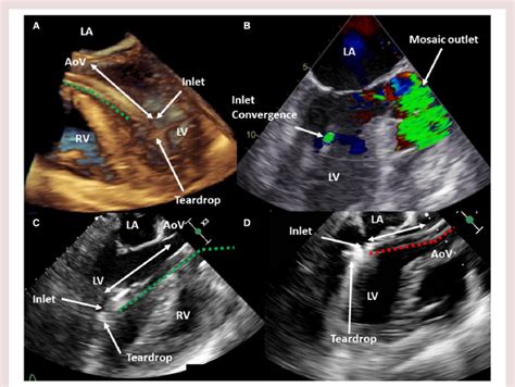 Percutaneous Left Ventricular Assist Device Position On Download Scientific Diagram