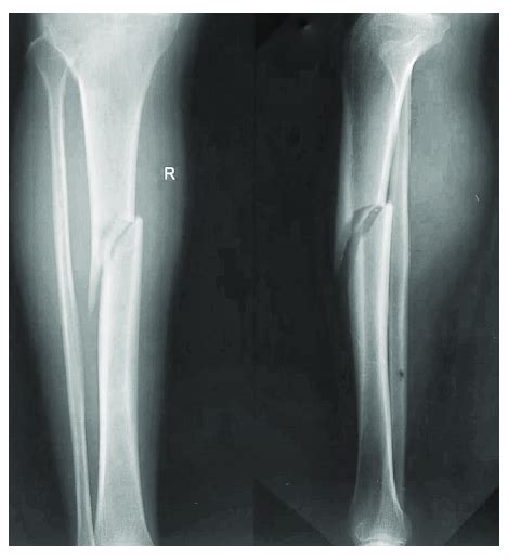 X Ray Right Leg Anterior Posterior And Lateral View Showing Spiral