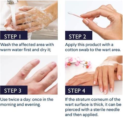 Best Wart Removal Treatment to Prevent Warts From Spreading!