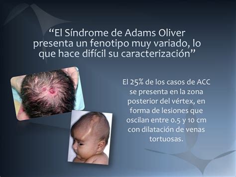 SÍndrome De Adams Oliver