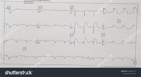 Стоковая фотография 1305057217: Extensive Anterior Wall Stemi | Shutterstock